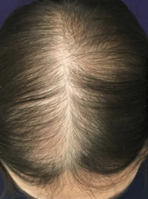 Close view of thinning hair and scalp